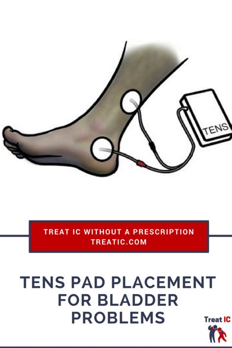 Tens Placement For Ic Help With Bladder Urgency And Frequency Treat Ic