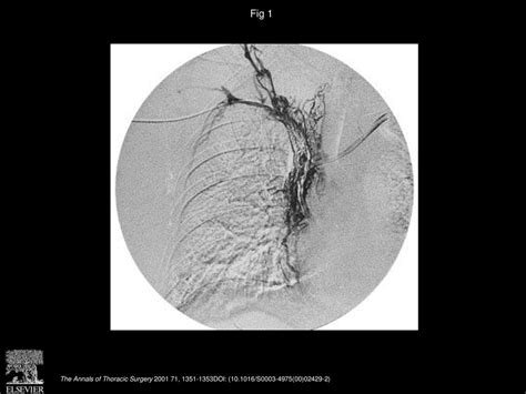 Surgical Repair Of Superior Vena Cava Syndrome Ppt Download