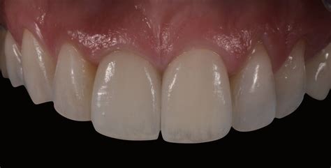 Clinical case - Frame structure without backing lingual support