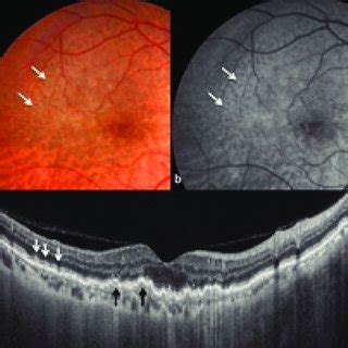 Multimodal Imaging Of A Case Of AMD A Fundus Photograph Shows