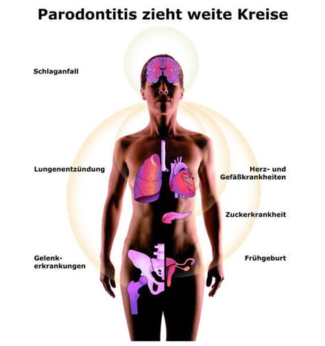 Gibt Es Einen Zusammenhang Zwischen Parodontitis Und Herzinfarkt