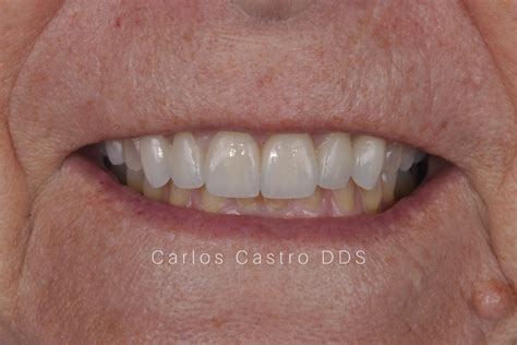 Rehabilitation Of A Patient With Bruxism And Clenching Gps Dental