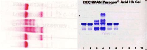 Chemistry Questions: Hgb Electrophoresis & Immunofixation & SPE Flashcards | Quizlet