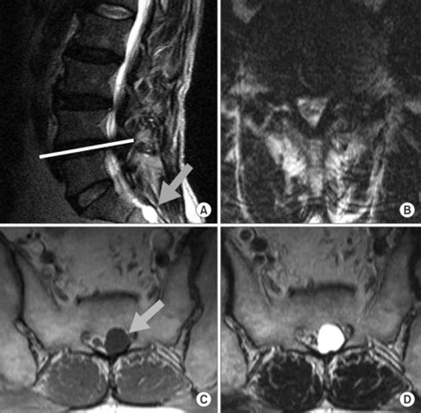 T2 Weighted Mr Images Show Disc Bulging And Spinal Sten Open I