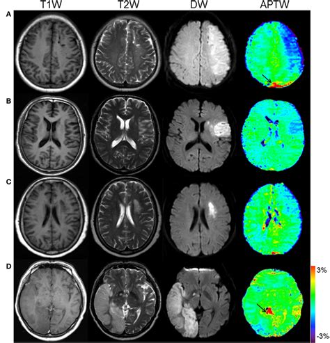 Frontiers Evolution Of Cerebral Ischemia Assessed By Amide Proton Transfer Weighted Mri