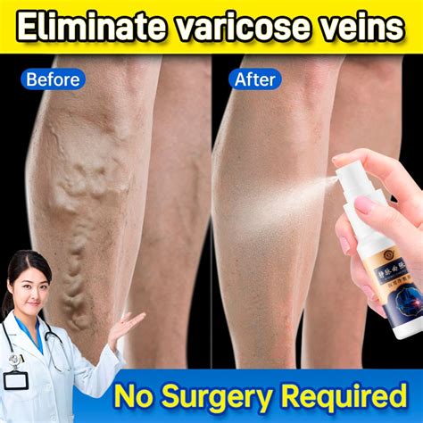 Varicose Veins Spray Varicose Veins Effective Remover Cream Varicose Veins Treatment Cream