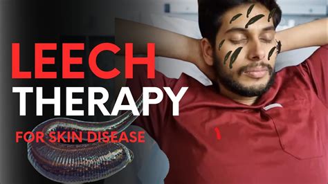 Leech Therapy To Cure Skin Diseases 😮 A Natural Approach Of Healing