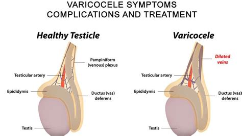 Varicocele Before And After Surgery