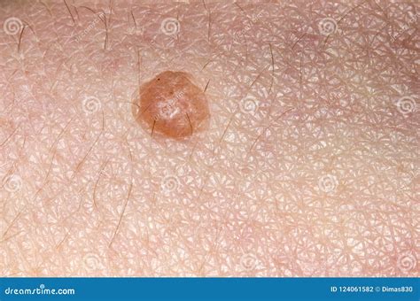 Benign Tumor Skin