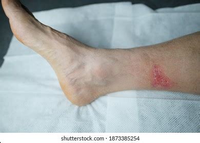 Skin Disease Lesion Ecchymosis Vasculitis Stockfoto