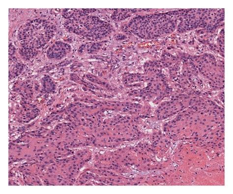 Histology Of Renal Tumor Of Case 1 Showing Squamous Cell Carcinoma H