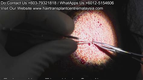 FUE HAIR TRANSPLANT LOWERING THE HAIRLINE Iplus Hair Regrowth Expert