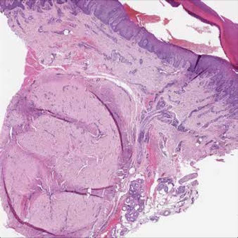 Recurrent Solitary Sclerotic Fibroma Storiform Collagenoma On The