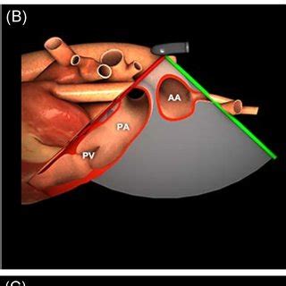 Upper Esophageal Aortic Arch Short Axis Ue Aa Sax View With