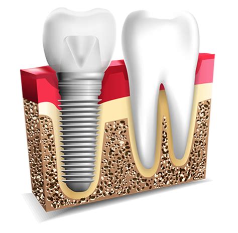 Implante Dental Premium Red Implantologia Viña