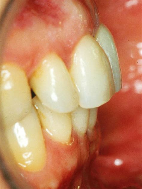 Riabilitazione Orto Implanto Protesica Clinica Odontoiatrica Centro