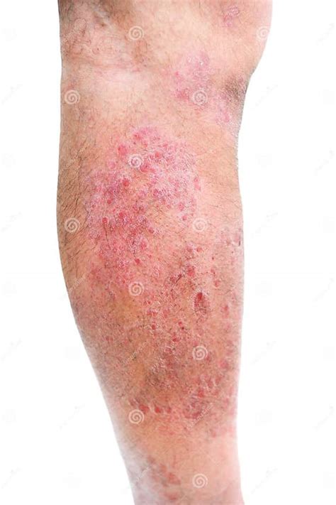 Atopic Dermatitis Ad Also Known As Atopic Eczema Is A Type Of Skin