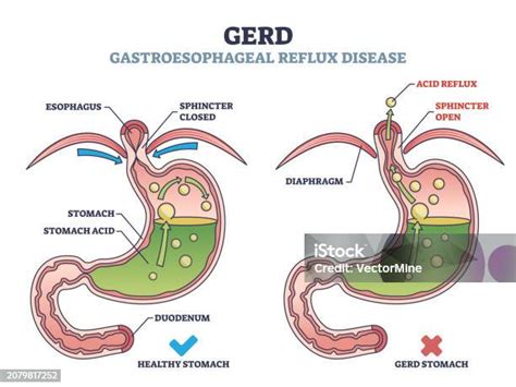 Gerd Or Gastroesophageal Reflux Disease With Digestive Acid Outline