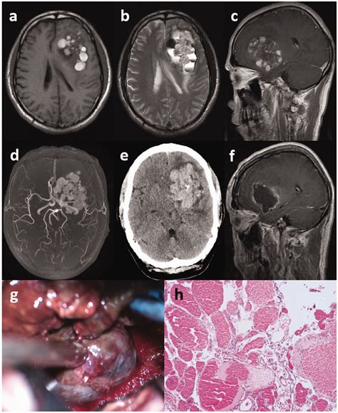 Rare Asymptomatic Giant Cerebral Cavernous Malformation In Adults Two