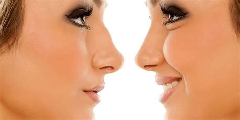 Rhinoplastie Lyon Comment Trouver Un Bon Chirurgien Total Sant