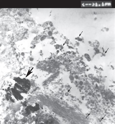 Figure 3 From Calcifying Nanoparticles Associated Encrusted Urinary