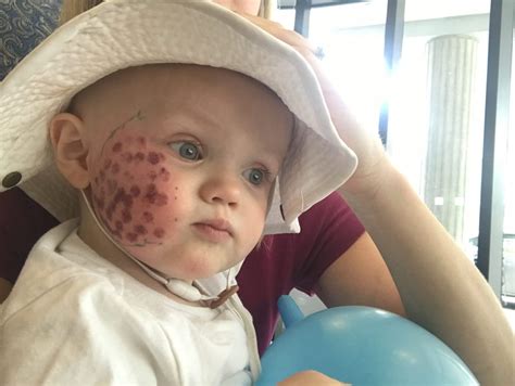 Vascular Birthmark Awareness Month: Our Port Wine Stain Story - Home ...