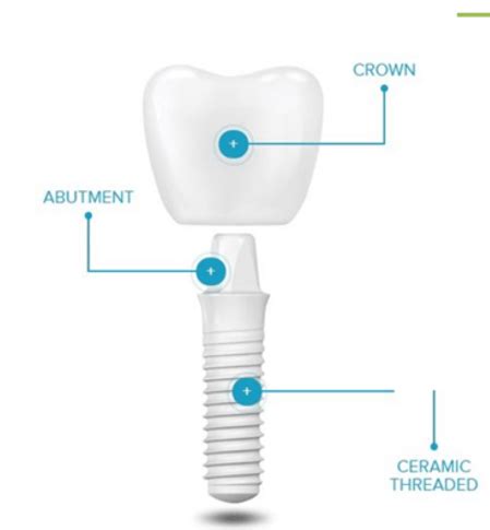 Ceramic Dental Implants Boca Raton, FL - Metal Free Implant Options