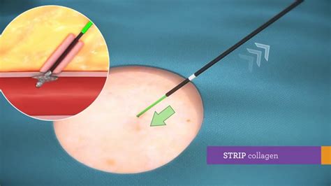 Cardiva Vascade Vascular Closure Device A Collagen Plug Youtube