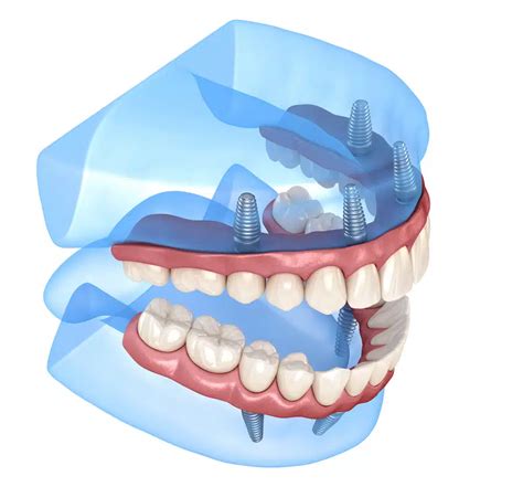 Best Dental Implants In Burnaby Burnaby Square Dental