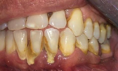 Scaling Root Planing Before And Stains