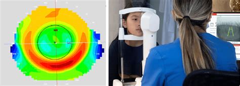 The Evolution of Orthokeratology Lens Fitting - Global Insight