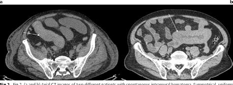 Pdf Findings In Spontaneous Intramural Intestinal Hematoma Imaging