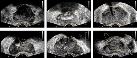 Example Segmentation Results Of The Prostate From Ultrasound Images