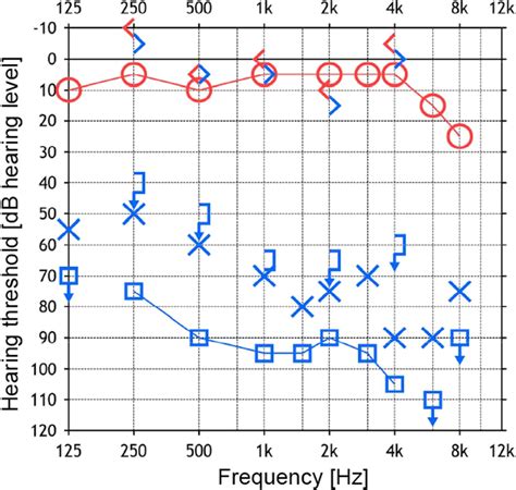 Profound Sensorineural Hearing Loss Audiogram