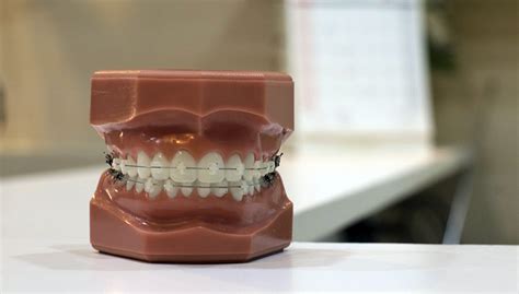 Orthodontie Classique Nos Bagues Dentaires à Sartrouville