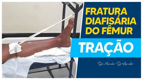 FRATURA DIAFISÁRIA DO FÊMUR TUDO QUE VOCÊ PRECISA SABER SOBRE OS