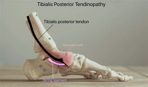 Adult Flat Foot Reconstruction Minimally Invasive David Redern