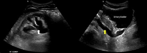 Hydroureter Ultrasound