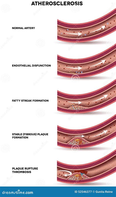 Stages Of Atherosclerosis Cartoon Vector | CartoonDealer.com #86262433