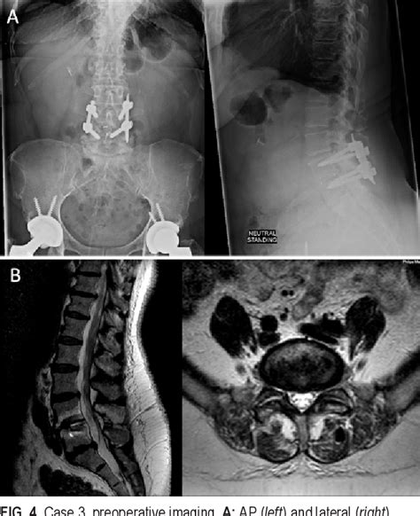 Figure 4 from Vulnerability of the L5 nerve root during anterior lumbar ...