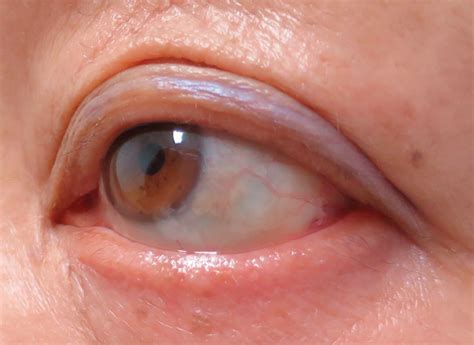 Hypothyroidism Eyelash Loss Cleveland Clinic Journal Of Medicine