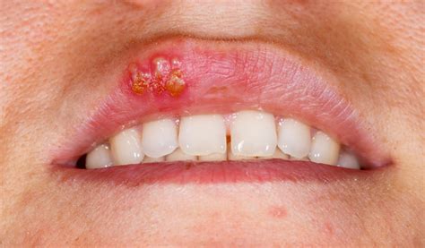 Herpes Lips