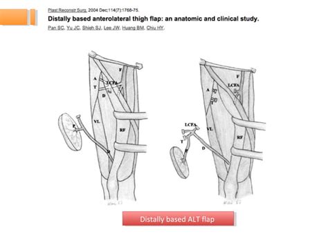 Plastic Surgery Idea & Innovation ~~ In-situ pedicle lengthening of ALT flap-final | PPT