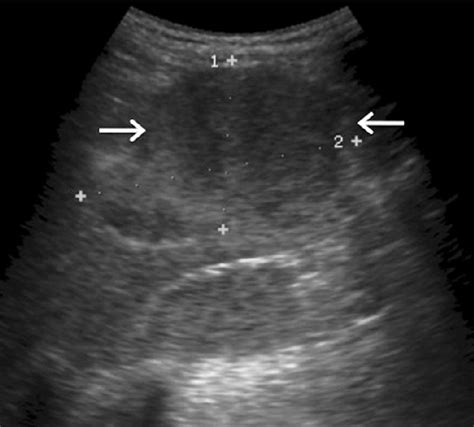 Liver Glycogen Storage Disease Ultrasound