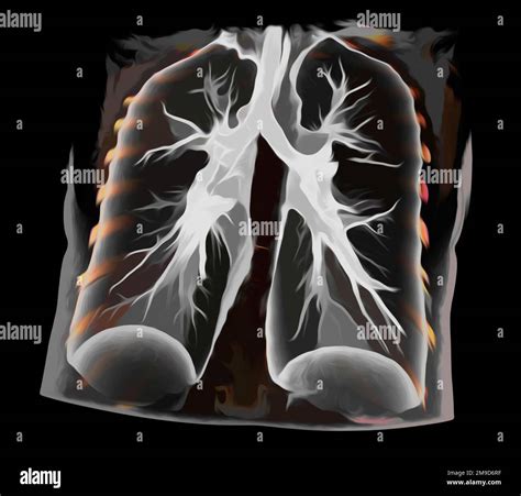 Healthy lungs, CT scan Stock Photo - Alamy