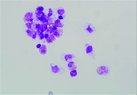 Photomicrograph of the cytology of the ascitic fluid. The ascitic fluid... | Download Scientific ...