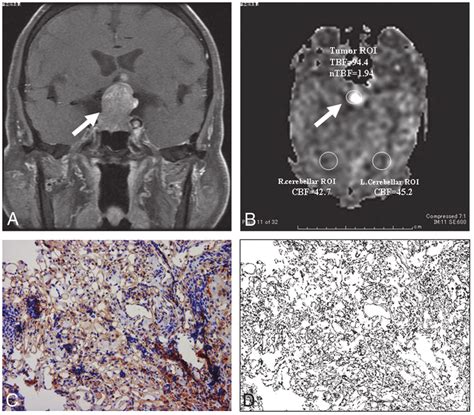 Nonfunctioning Pituitary Macroadenoma With Hypervascularity In A