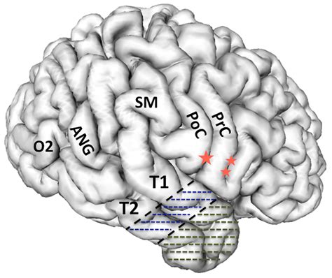 Brain Sciences Free Full Text Surgical Considerations Of