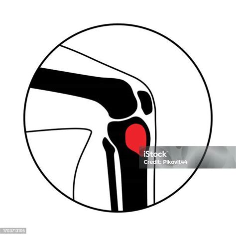 Tibia Bone Osteomyelitis Stock Illustration Download Image Now