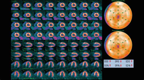 Pet Myocardial Perfusion Imaging In The Assessment Of Coronary Artery